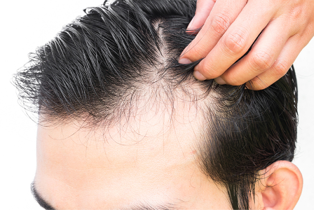 3 Non-Surgical Hair Loss Treatments That You Should Consider