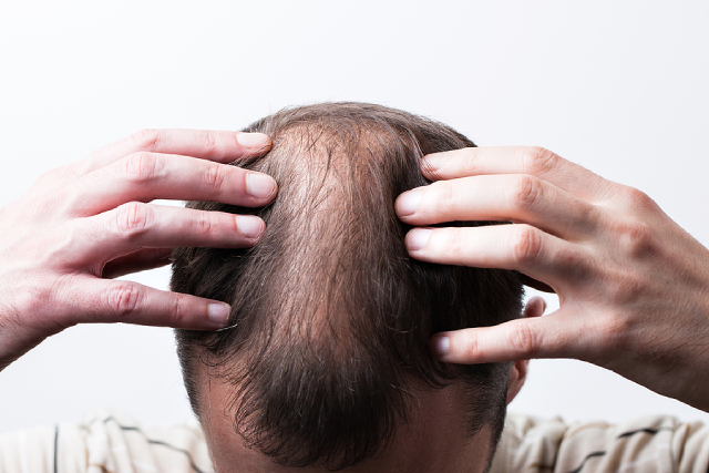 Everything You Need To Know About Male Pattern Baldness