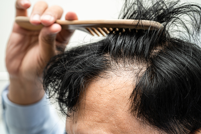 Common Hair Loss Treatment Mistakes You Can Easily Avoid