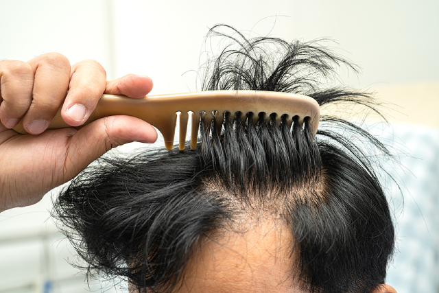 Receding Hairline: What Is It And How Do You Prevent It?