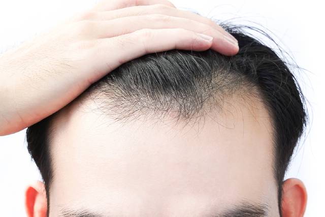 The First Signs Of Male Hair Loss: What To Look Out For