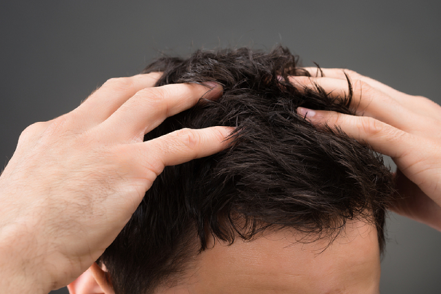 Can Dandruff Lead to Hair Loss? Causes and How to Treat It